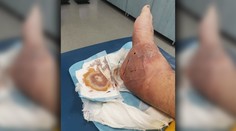 Banálna zlomenina sa skončila amputáciou nohy. Peter z toho viní lekárov