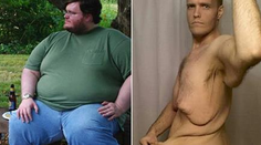 Neuveriteľné: Muž schudol 177 kg, stále však nevyzerá dobre