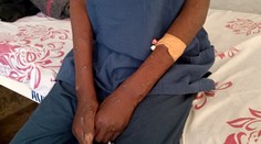 Európa čelí novej zdravotnej kríze. Krajinami sa šíria opičie kiahne