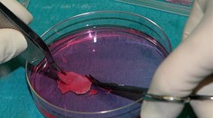 Žena ako prvá na svete porodila po transplantácii časti vaječníka