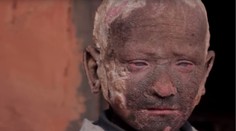 Ťažký osud chlapca: Pred očami bezbranných rodičov sa mení na skalu