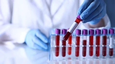 Jednoduchý krvný test môže odhaliť vážnu chorobu ešte skôr, než začnete zabúdať