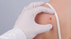 Nebezpečnej rakoviny kože z roka na rok pribúda, najviac sú ohrozené ženy