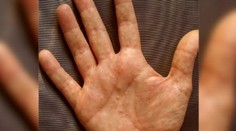 Aj jedlo a chladné počasie môže zhoršiť ekzém