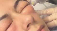 Z tohto estetického zákroku ide strach. Zježia sa vám chlpy