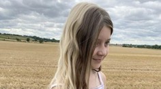 Bella (11) má od narodenia dve farby vlasov. Za všetko zrejme môže táto porucha