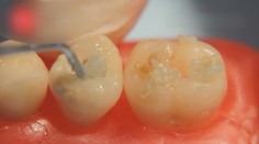 Už žiadne vŕtačky pri zubnom kaze. Niektorí zubári začali používať novú metódu