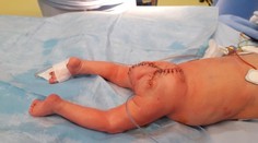 Pražským lekárom sa podaril husársky kúsok: Bábätku zmenšili obrovský nádor ešte v maternici