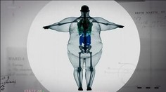 Ako vyzerá 400-kilový muž pod röntgenom? Pozrite sa na ten kontrast