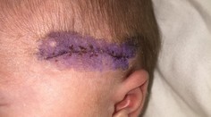 Rodila cisárskym rezom. Lekár porezal hlavičku bábätka