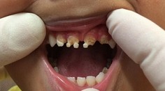 Znepokojujúce fotky detských zubov. Toto spôsobujú sladené nápoje