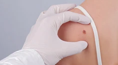 Neviete, či sú vaše znamienka bezpečné? Prinášame vám rozhovor s dermatologičkou