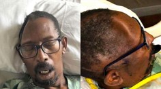 Lekári pred plánovanou operáciou stratili časť lebky pacienta. Reakcia nemocnice je zarážajúca