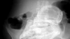 Lekári v šoku: Dôchodkyni našli v tele 40-ročné „skamenené dieťa"