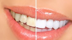 Túžite pred letom po žiarivom úsmeve? Stačí málo