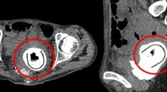 Takmer 13-centimetrovú hračku mala vo vagíne 10 rokov!