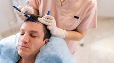 Nové vlasy nový život: Ako prebieha moderná transplantácia vlasov?