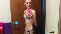Bola som kostra. Tia pre anorexiu krvácala z nosa a bolelo ju celé telo