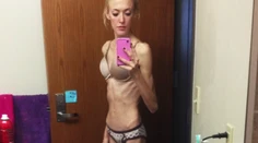 Bola som kostra. Tia pre anorexiu krvácala z nosa a bolelo ju celé telo