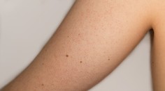 Máte takéto červené bodky na rukách? Vieme, čo znamenajú