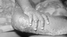 Príznaky sú na začiatku podobné chrípke. Opičie kiahne, ktoré strašia Európu, sa môžu objaviť aj u nás