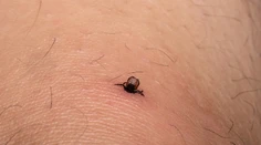 Zostal vám po vybratí kúsok kliešťa v koži? Lekárka radí, čo s ním určite nerobiť