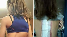 Dievča trpí vzácnou chorobou. Chrbticu mala o 55 stupňov vykrivenú
