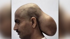 FOTO: Mal akoby dve hlavy. Mužovi odoperovali vzácny nádor gigantickej veľkosti