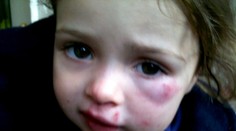 Dievčatko (2) brutálne dobila jej kamarátka v škôlke