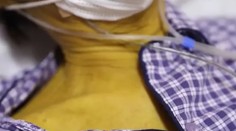 Farba mužovej pokožky sa odrazu zmenila na žltú. Lekárom sa napokon podarilo zistiť príčinu