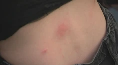 Štípanec veľký ako polovica nohy. Aj komár vás môže dostať na urgent