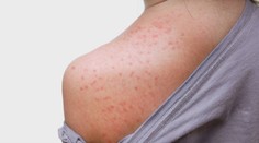 Medzi deťmi sa vo veľkom šíri piata choroba. Takéto má prejavy