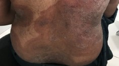 Európou sa valí superpleseň: Vedci varujú, že o chvíľu pred ňou nebude úniku. Postihuje celé telo, liečba je náročná