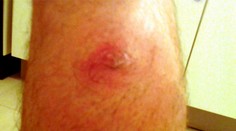 Slovákov trápi hmyz. Pozor na nebezpečné agresívne štípance