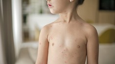 Osýpky sú nebezpečne blízko. Z Česka hlásia 30 prípadov