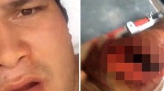 Muž zverejnil surové video. Žralok ho uhryzol do nohy