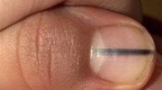 Manikérka ju upozornila na zvláštnosť na nechte, vykľula sa z toho rakovina