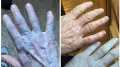 Muž sa zobudil a zistil, že je celý modrý. Príčina dostala do kolien aj lekárov