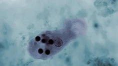 Mužovi požierala pečeň améba. Keď lekári skúmali, ako sa tam dostala, prišli k nečakanej odpovedi