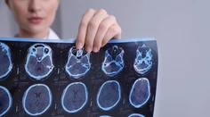 Vedci odhalili bunky, ktoré ničia mozog. Objav môže zmeniť liečbu sklerózy