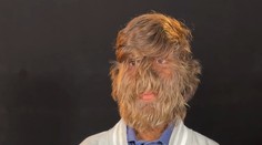 Mladík má vzácny vlkolačí syndróm. Získal vďaka tomu svetový rekord