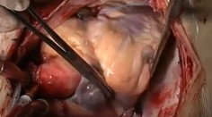 Takéto niečo sa len tak často nevidí! Fascinujúce video transplantácie srdca