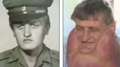 Slovákovi odstránili šesťkilový tumor. Píšu o ňom aj vo svete!