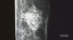 Nádor na prsníkoch neohrozuje len ženy. U mužov je ochorenie výrazne agresívnejšie