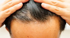 Známy liek proti vypadávaniu vlasov môže vyvolať myšlienky na samovraždu. Predajcovia podceňujú riziká