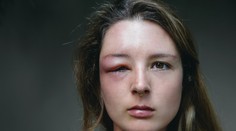 Nevyspytateľné opuchy, bolesti a riziko zadusenia. Čo je to heditárny angioedém a koho postihuje?