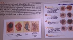 Kontrolujete si znamienka? Do konca mája to môžete urobiť zadarmo