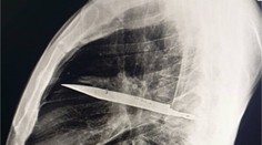 Prípad, ktorý šokoval lekárov. Muž žil osem rokov s nožom v hrudi
