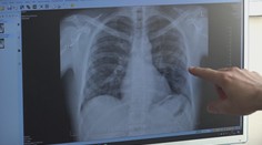 Po Európe sa šíri nepríjemná baktéria. Spôsobuje zápal pľúc, najmä u mladých ľudí