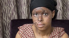 Ženská závisť je nebezpečná! Naomi znetvorila jej žiarlivá kamarátka